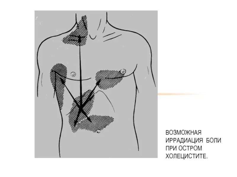 Иррадиация сердца. Иррадиация болей при остром холецистите. Локализация боли при холецистите. Острый холецистит локализация боли. Локализация боли при остром холецистите.