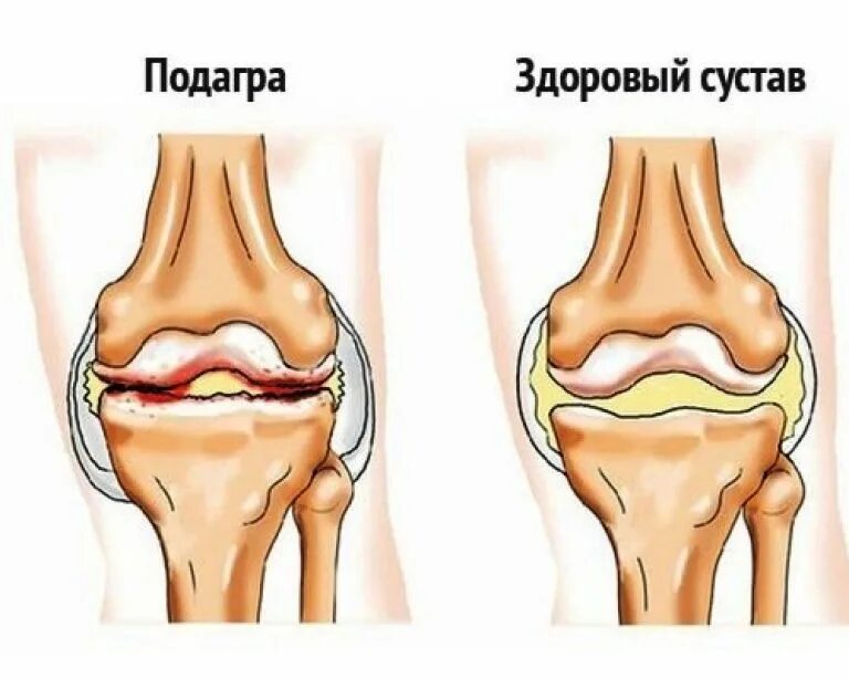 Артроз коленного сустава симптомы. Артроз коленного сустава симптомы