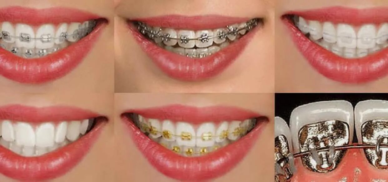 поставить зуб сколько в казани. внутрикостная дентальная имплантация. Neodent импланты. поставить зуб сколько в казани. имплантаты neodent неодент бразилия.