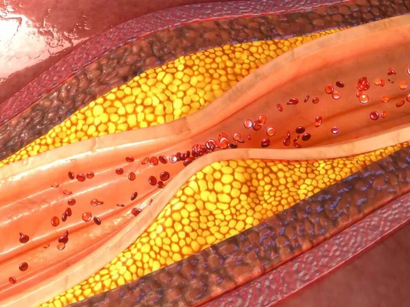 Отложение холестерина. Атеросклерозные бляшки.