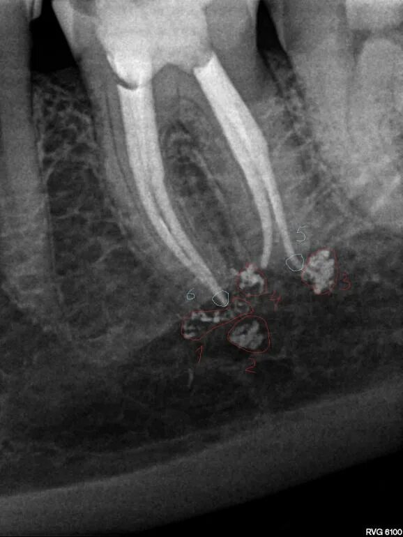 Рассосался корень зуба. Запломбированные корневые каналы.