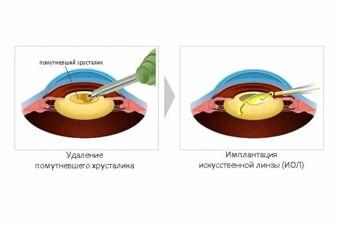 Катаракта факоэмульсификация. Искусственный хрусталик глаза. Замена хрусталика схема. Операция по замене хрусталика глаза.