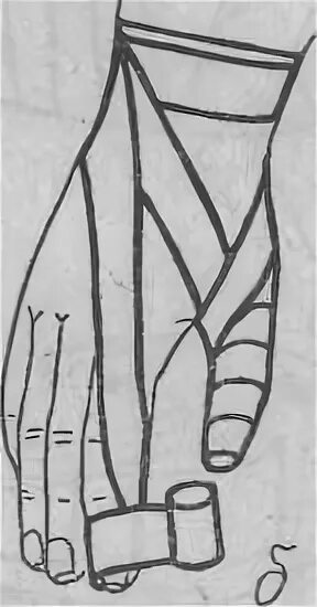 Техника наложения повязки перчатка