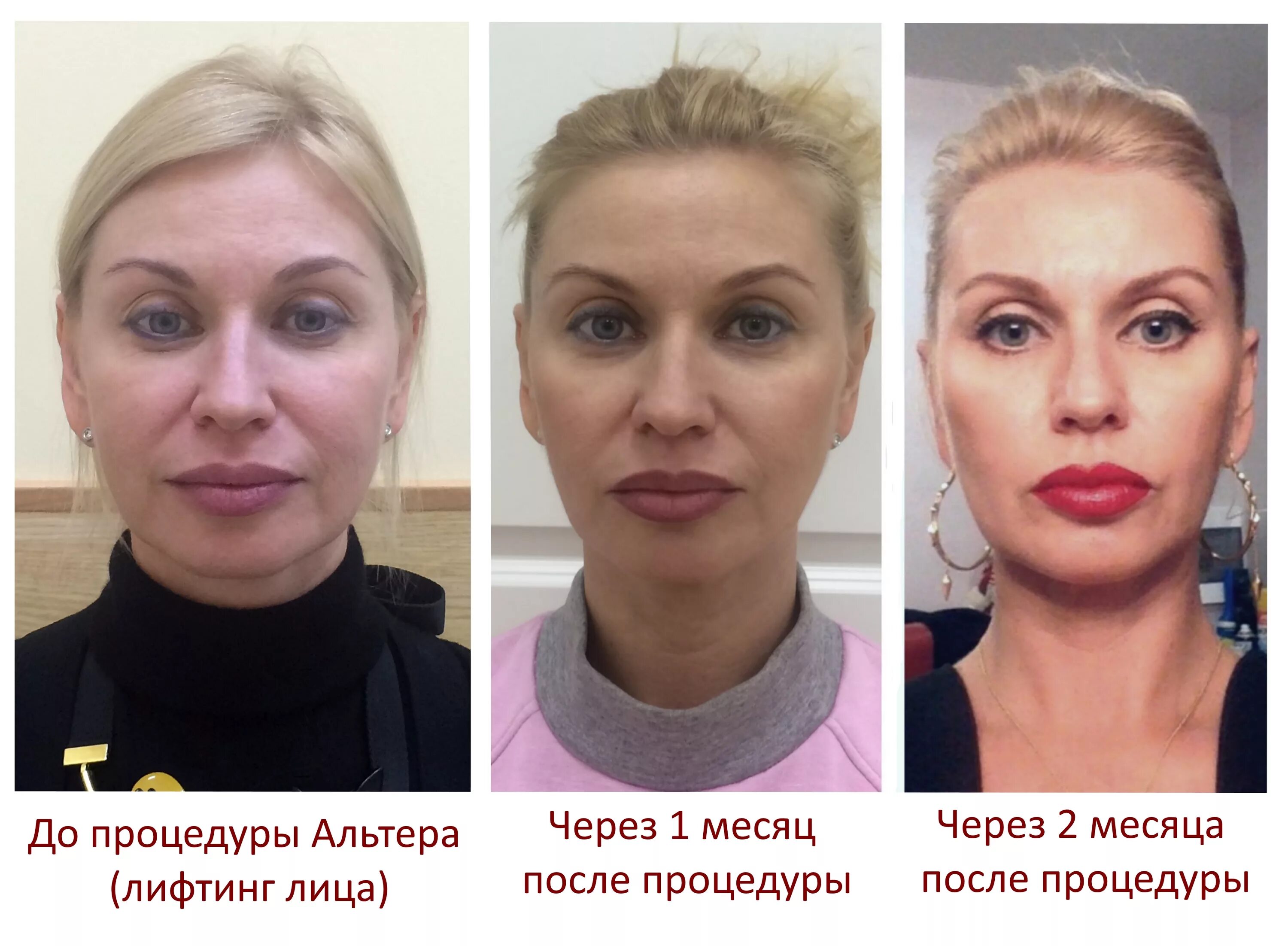 Подтяжка лица спб