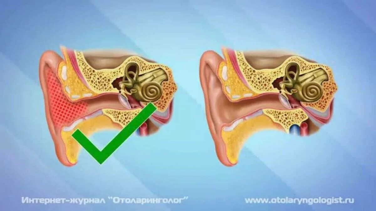 Строение уха серная пробка. Ухо серная серная пробка. Анатомия уха серная пробка. Заложило ухо пробка что делать