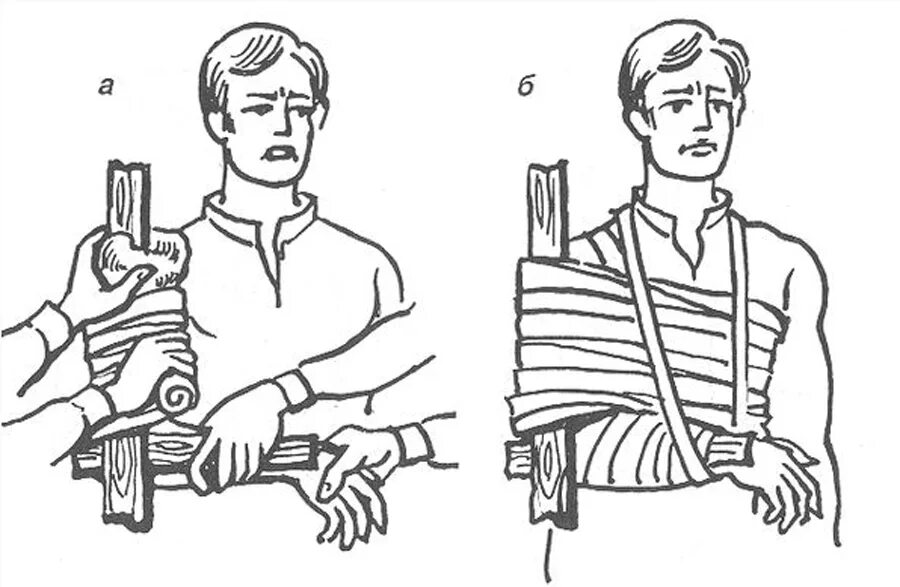 Д3 при переломах. Иммобилизация при переломе плечевой кости. Наложение шины Крамера при переломе руки. Наложение шины Крамера при переломе костей предплечья. Иммобилизация при переломе плечевой плечевой кости.