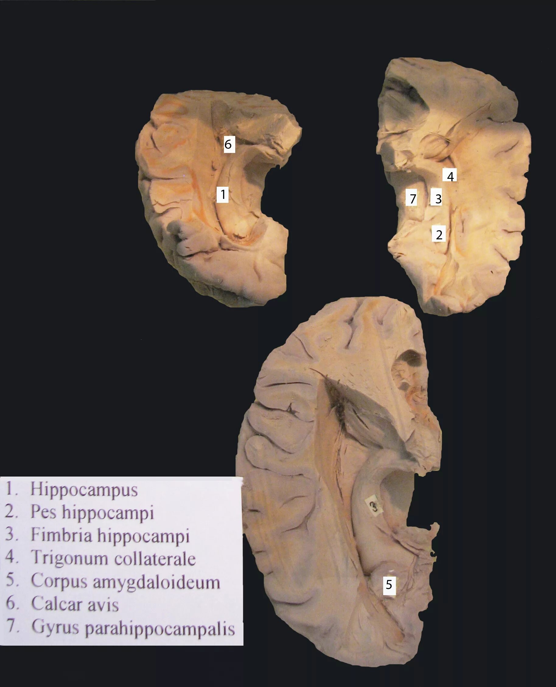 Повреждение гиппокампа. Гиппокамп анатомия. Гиппокамп мозга. Trigonum collaterale мозг. Fímbria Hippocámpi анатомия.