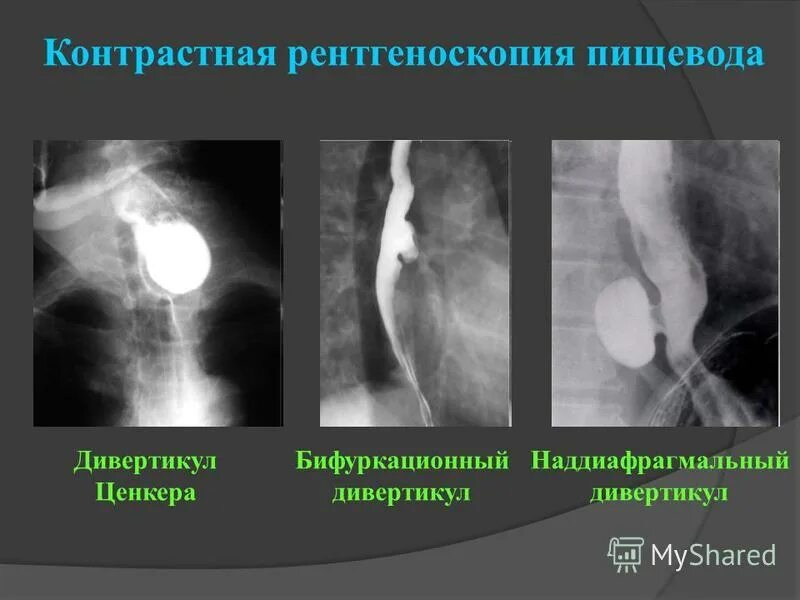 Ценкеровский дивертикул рентген. Пульсионные дивертикулы пищевода. Дивертикул пищевода Ценкера рентген. Дивертикул Ценкера рентген.