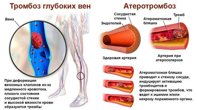 Тромбоз фильтры