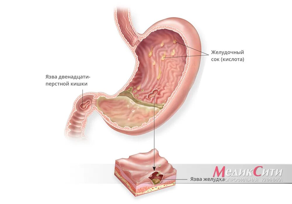 Болезни двенадцатиперстной кишки у ребенка. Язвенная болезнь желудка и 12 перстной кишки. Язва желудка и 12 перстной кишки. Пенетрирующая язва желудка и 12-перстной кишки. Язвенная болезнь желудка и 12-перстной кишки. Гастрит..