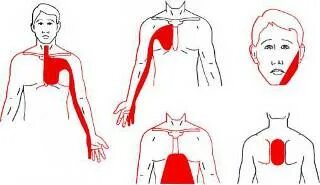 Стенокардия иррадиация. Стенокардия иррадиация болей. Инфаркт миокарда иррадиация боли. Иррадиация при стенокардии. Иррадиация боли в нижнюю челюсть