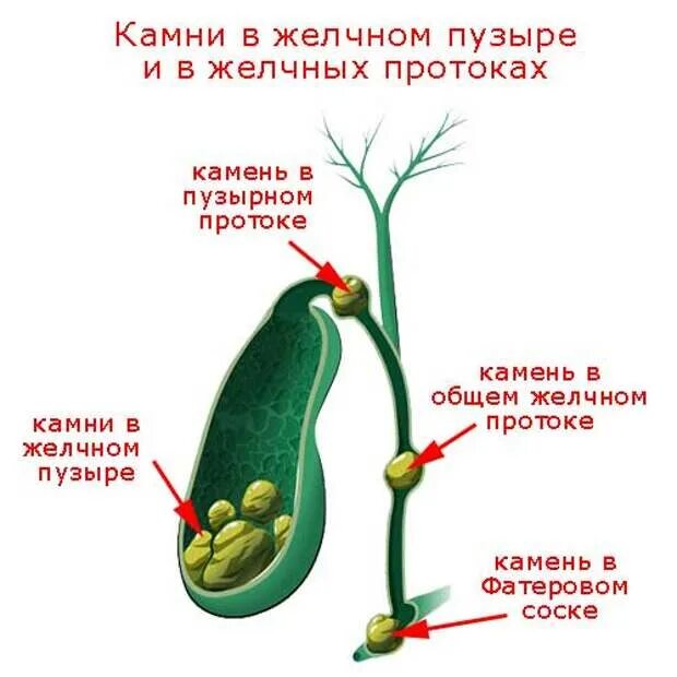 Удаление камня через проток. Схема формирования желчных камней. Камни в желчных протоках.