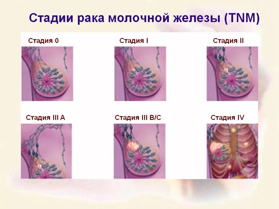 Виды рака молочной железы: по гистологическому типу и характеру образования - По
