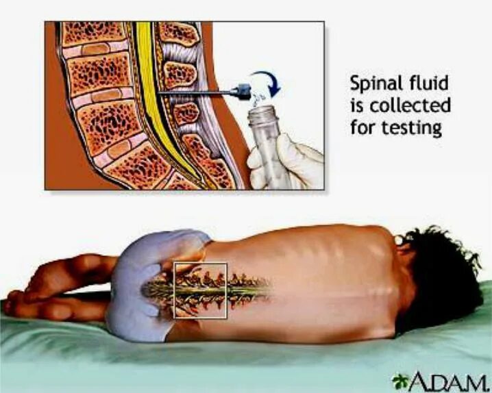 Как делают пункцию мозга. Люмбальная пункция ликвора. Люмбальная пункция при менингококковой инфекции. Спинномозговая пункция при менингите. Люмбальная пункция позвоночника.