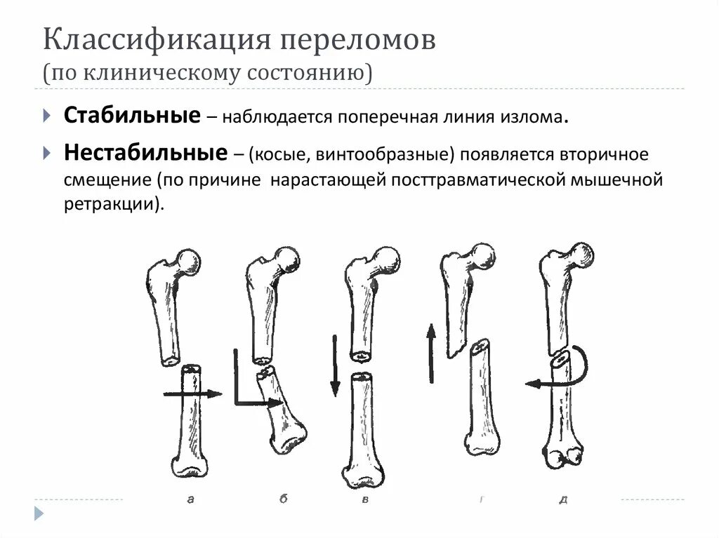 5 групп костей. Смещение отломков при переломе классификация. Переломы со смещением классификация. Классификация переломов нижних конечностей. Классификация смещений костных отломков.