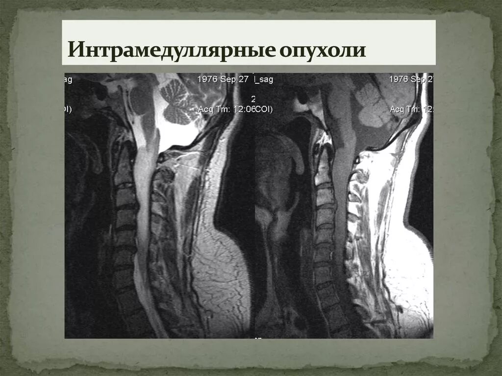 Интрамедуллярная спинальная опухоль. Интрамедуллярная опухоль спинного мозга. Миелография опухоли спинного мозга экстрамедуллярные. Интрамедуллярная опухоль спинного мозга мрт. Интрамедуллярные опухоли спинного