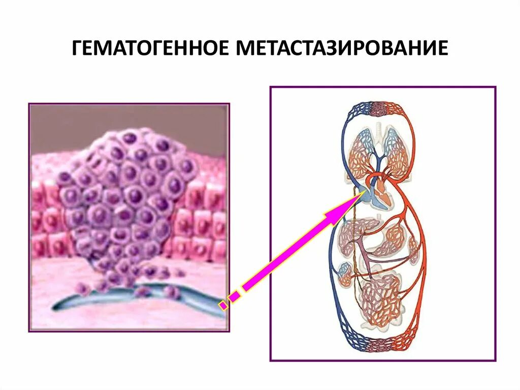 Гематогенное метастазирование. Метастазирование опухолей. гематогенный путь метастазирования. гематогенное метастазирование опухоли.