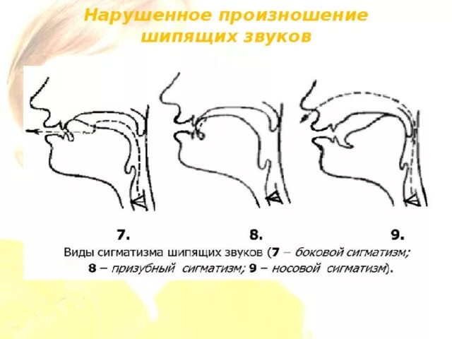 Нарушено произношение звуков. Сигматизм свистящих звуков. Межзубный сигматизм шипящих звуков. Положение языка схема. Межзубный сигматизм артикуляционный профиль звука.