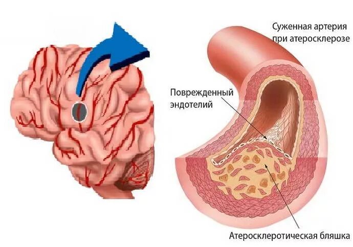 Лечение церебрального атеросклероза сосудов головного. Атеросклероз церебральных сосудов. Атеросклероз сосудов мозга. Атеросклероз артерий головного мозга. Бляшка в сосудах головного.