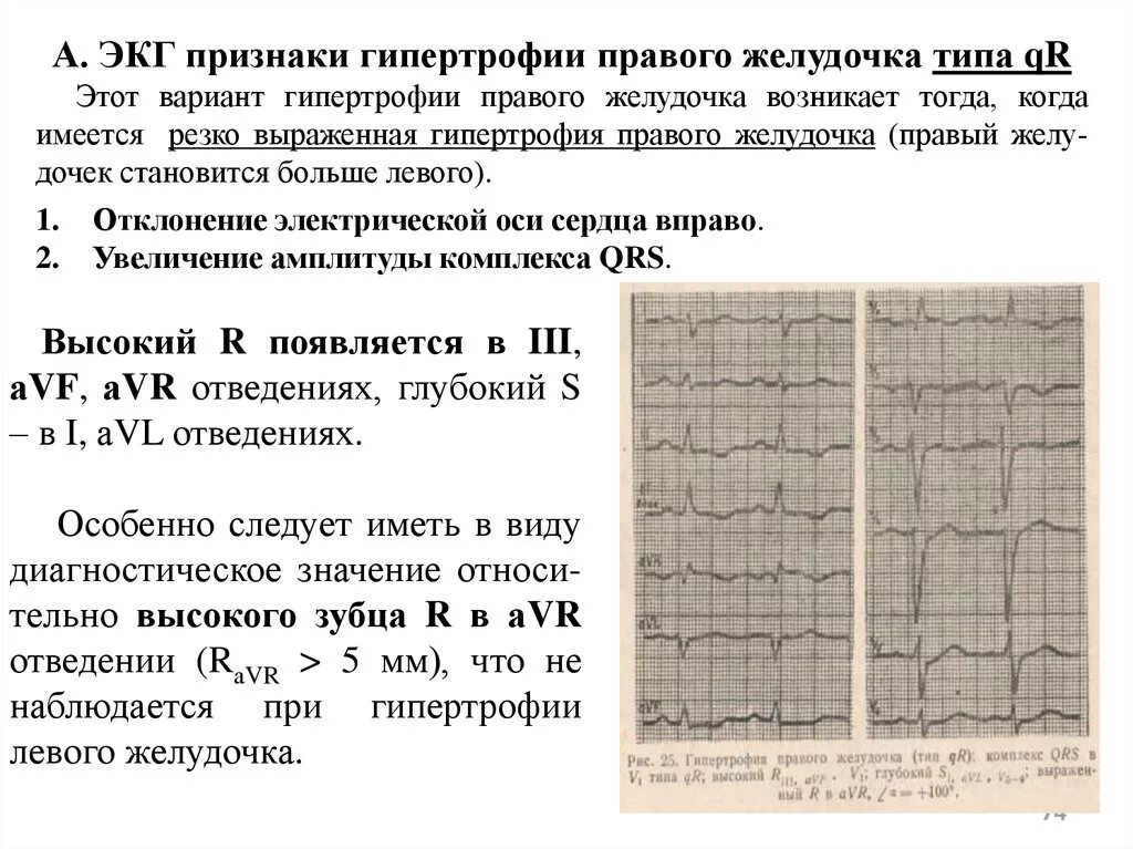 Очаговые изменения левого желудочка. Гипертрофия миокарда лж на ЭКГ. Признаки гипертрофии желудочков на ЭКГ. ЭКГ при гипертрофии желудочков сердца. Гипертрофия левого желудочка на ЭКГ кардиограмма.