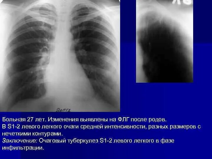 Очаговые тени средней интенсивности. Очаг средней интенсивности в легких. Очаг s1-2 левого легкого. Тень в левом легком