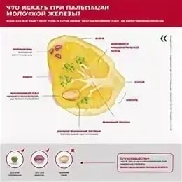 4 стадия молочной железы