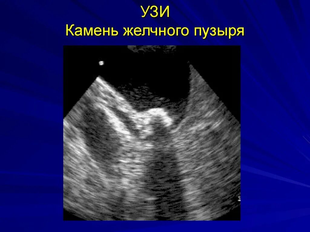Камень в шейке желчного пузыря. УЗИ желчного пузыря ЖКБ. Камни в желчном пузыре УЗИ.