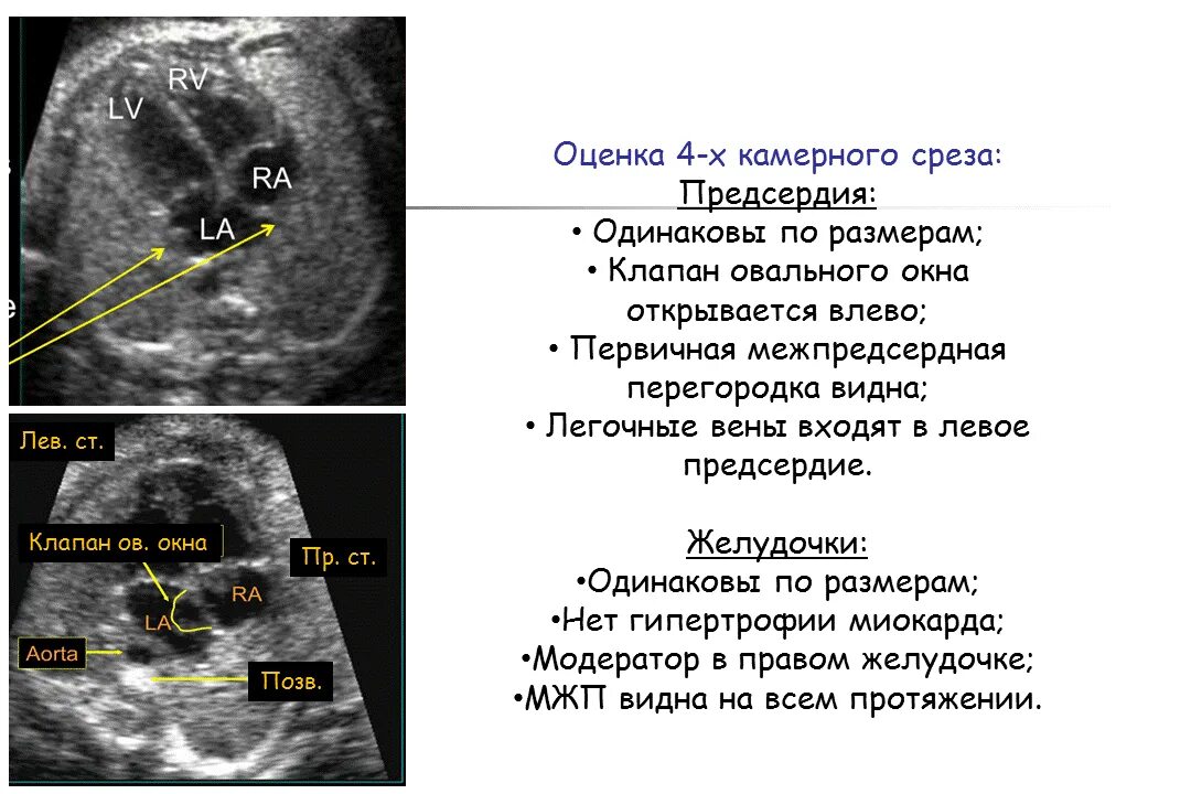 Четырехкамерный срез сердца. 4 Камерный срез сердца у плода. 4 Камерный срез сердца n. 4х камерный срез сердца ищменен. 4 Х камерный срез сердца у плода осмотр затруднен.