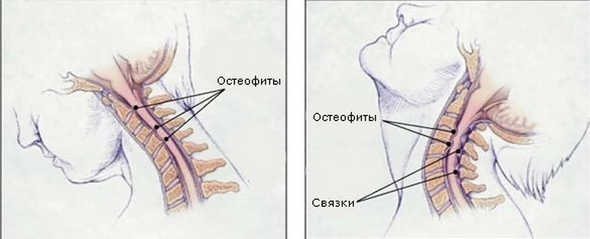 Остеофиты что это такое и как лечить. Остеофиты шейного отдела позвоночника. Краевые остеофиты шейного отдела позвоночника. Задние остеофиты шейного отдела позвоночника. Спондилёз шейного отдела позвоночника что это такое.