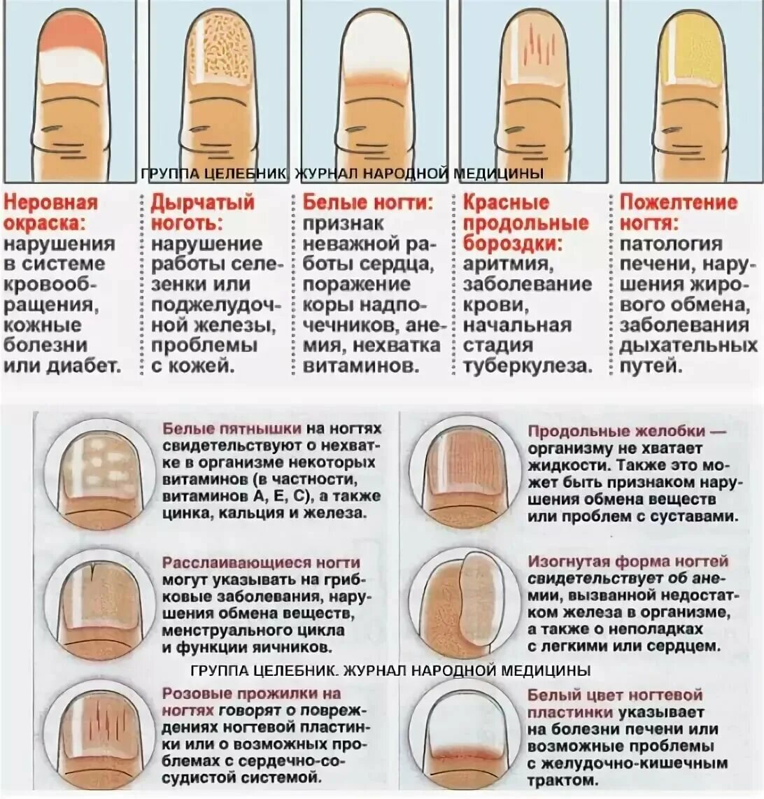 Самые распространенные болезни ногтей. Заболевания по ногтям рук. Признаки болезней по ногтям. Продольные полосы на ногтях. Определить болезнь по ногтям.