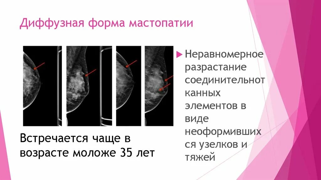 Формы фиброзно-кистозной мастопатии. Кистозно фиброзная мастопатия на маммографии. Диффузия фиброзно-кистозной мастопатии молочных желез. Диффузная фиброзно-кистозная мастопатия молочных желез что это.