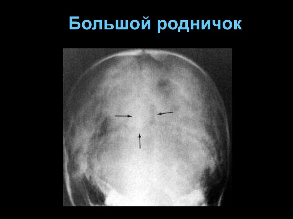 Рентгеноанатомия костей черепа. Большой Родничок. Рентген головы новорожденного Родничок. Измерение большого родничка.