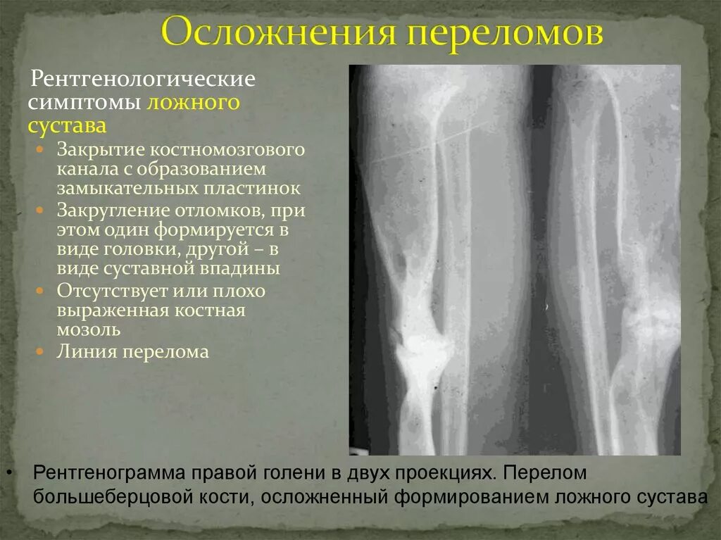 Ложный сустав плечевой кости рентген. Рентгенологический диагноз ложного сустава. Ложный сустав берцовой кости. Ложный сустав рентген признаки. Возможное осложнение перелома