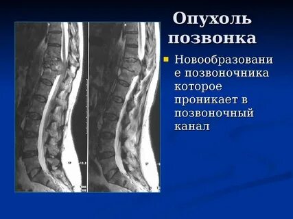 Отек позвонков поясничного отдела