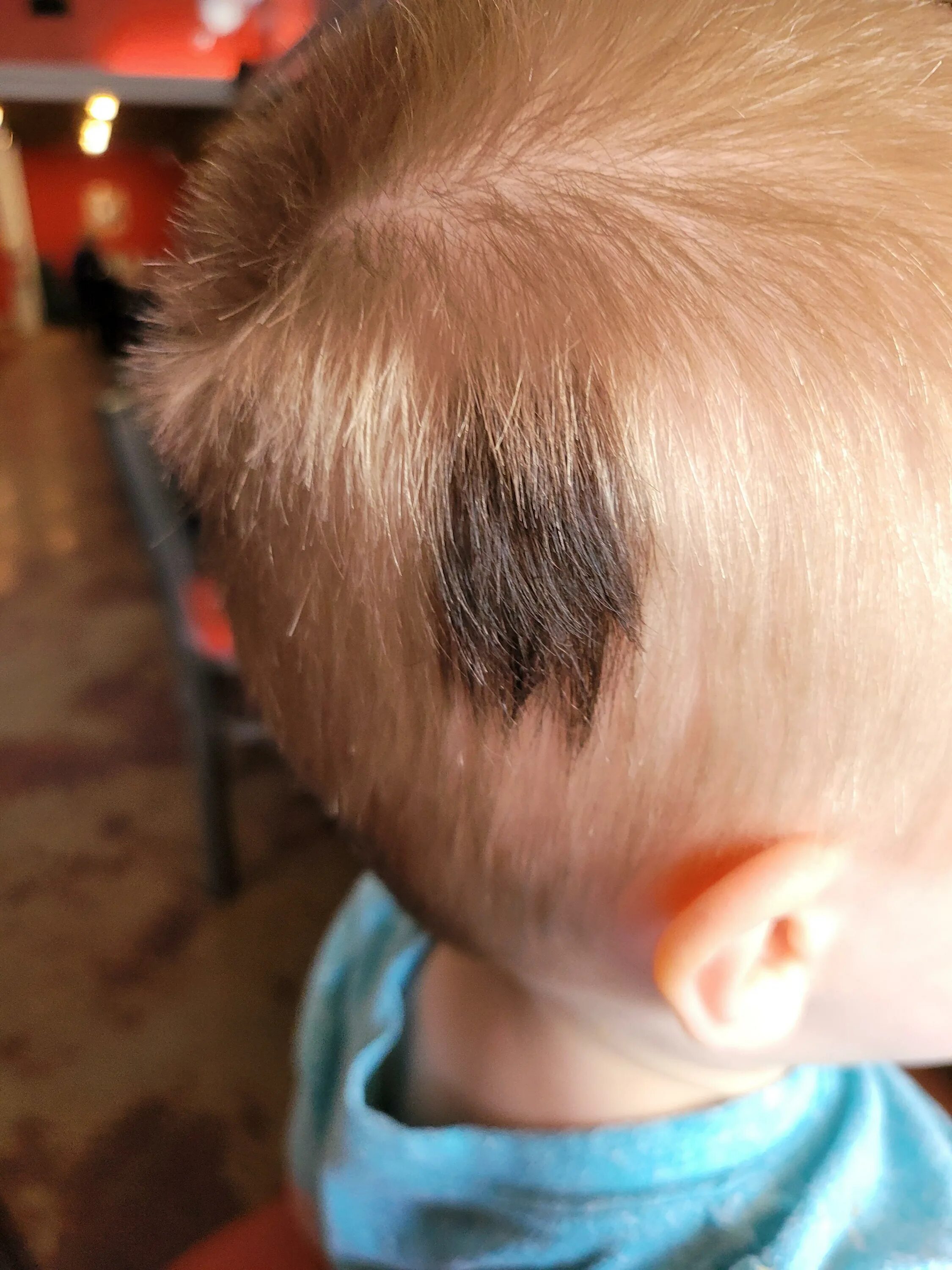 Пятно на волосах. Родимое пятно в волосах на голове. Родимое пятно на голове у ребенка.