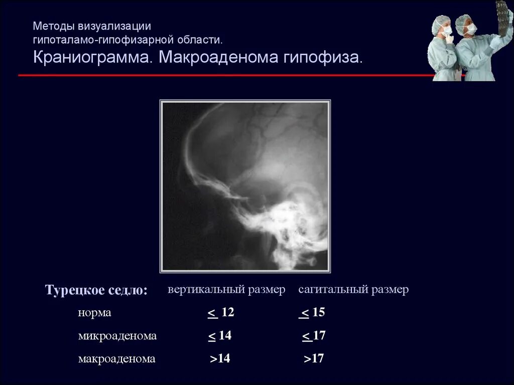 Размер гипофиза. Размеры турецкого седла в норме. Размеры гипофиза у женщин. Турецкое седло рентген норма. Турецкое седло рентген Размеры.