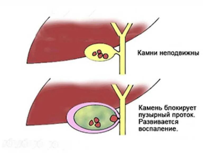 Острый холецистит хирургические. Острый калькулезный холецистит холедохолитиаз. Острый калькулезный холецистит этиология. Патогенез калькулезного холецистита. Хронический холецистит клиника.