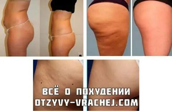 Как Похудеть В Животе И Боках Женщине После 50 Без Вреда Для Здоровья Отзывы - 5