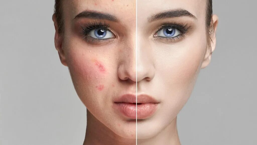 Acne prone Skin.