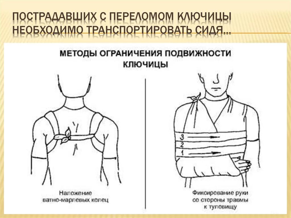 Оказание первой помощи при переломе ключицы. Транспортная иммобилизация при переломе ключицы. Мобилизация при переломе ключицы. ПМП при переломе ключицы.