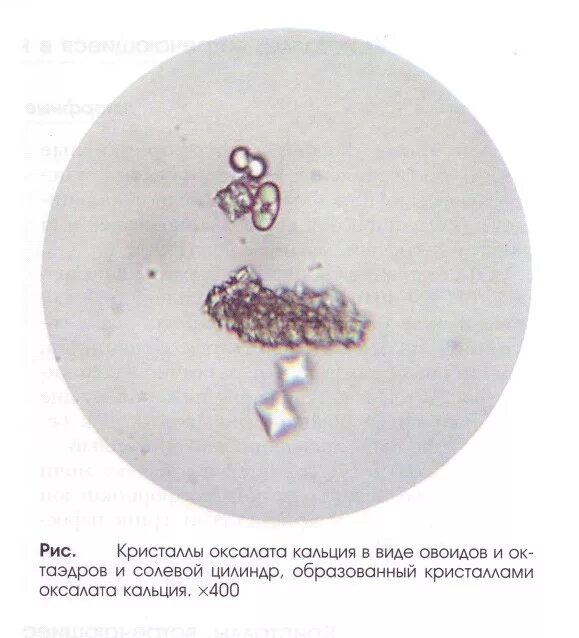 Оксалаты кальция в моче у мужчин. Кристаллы оксалата кальция микроскопия. Оксалат кальция моногидрат в моче. Кристаллы оксалата кальция в моче. Оксалат кальция дигидрат в моче.