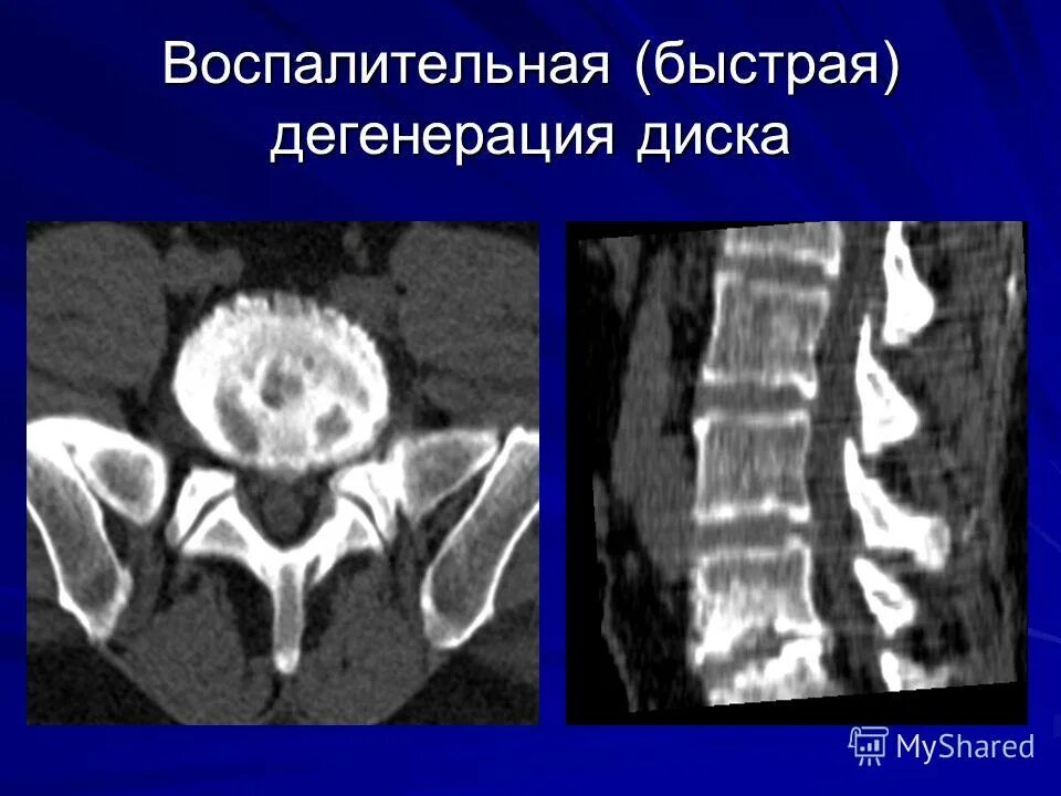 Дегенерация дисков