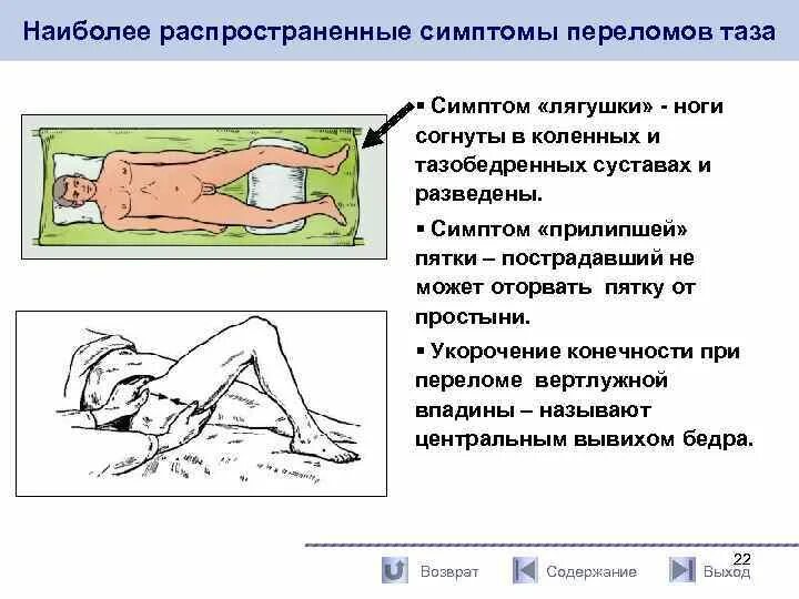 Нагрузочные тесты при переломе таза. Характерные симптом при переломе костей таза. Симптом прилипшей пятки. Симптом прилипшей пятки при переломе таза. Прилипшая пятка характерна