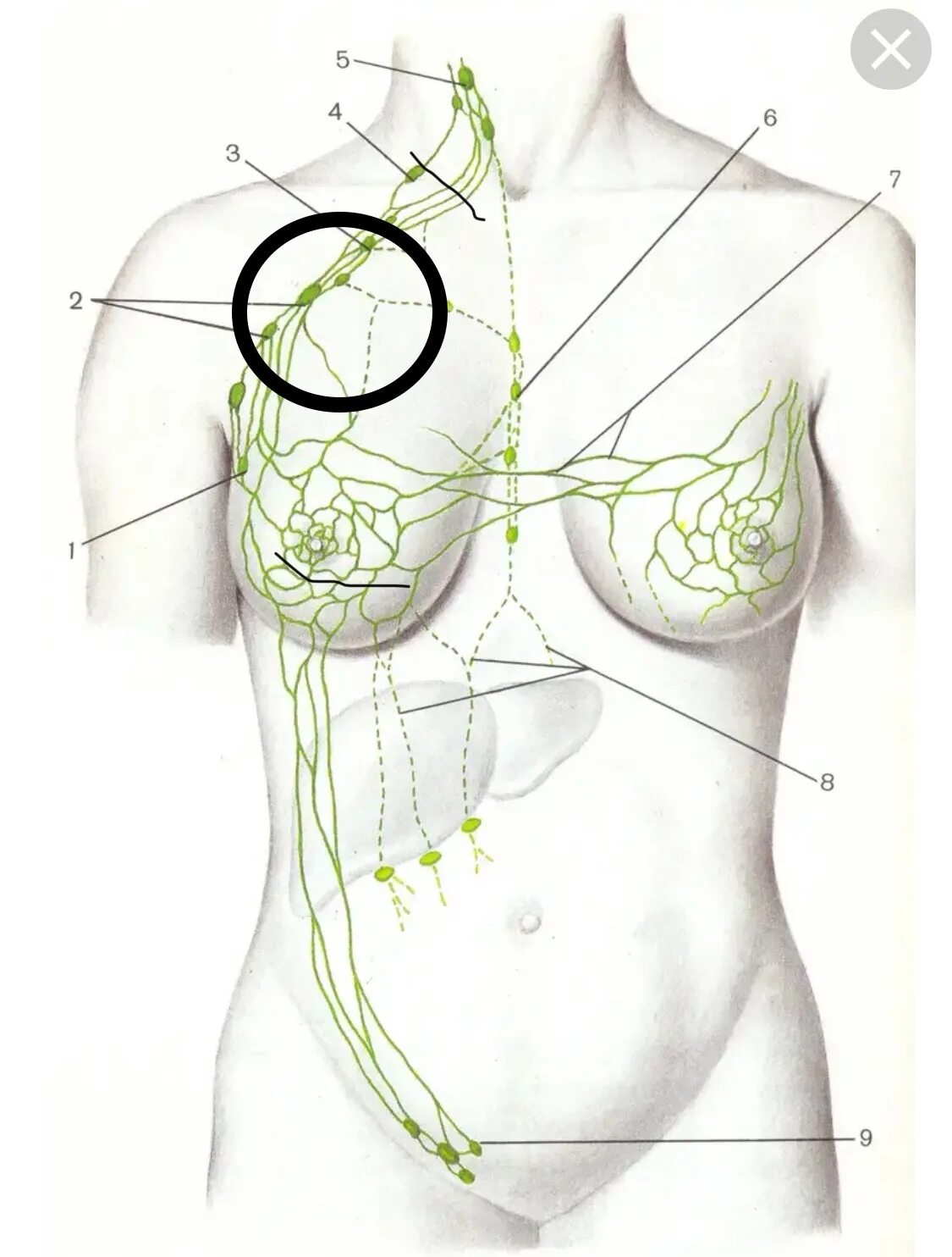 Лимфоузлы под мышками расположение у женщин. Подключичные лимфоузлы расположение схема. Надключичные лимфатические узлы расположены. Надключичные лимфоузлы узлы. Надключичные лимфоузлы схема.
