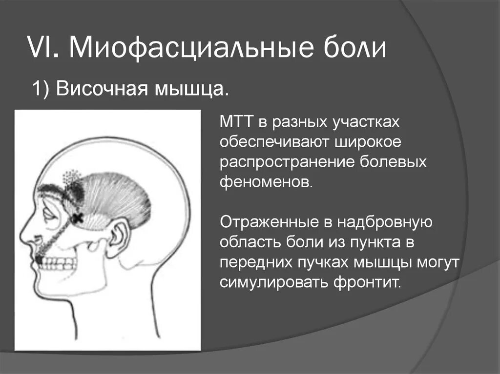 Миофасциальный болевой синдром мышц лица. Миофасциальный синдром жевательных мышц. Воспалена височная мышца. Боли в правой височной области