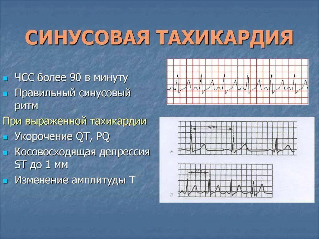 Синусовая тахикардия ЧСС 100 ЭКГ. ЭКГ тахикардия синусовый ритм ЧСС 90. Синусовая тахикардия максимальная ЧСС. Синусовая тахикардия с ЧСС 110 уд/мин..