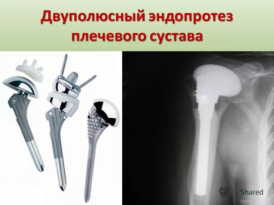 Ограничения после эндопротезирования. Однополюсное эндопротезирование плечевого сустава. Двухполюсный эндопротез тазобедренного сустава. Эндопротез плечевого сустава Stryker. Эндопротез локтевого сустава Зиммер.