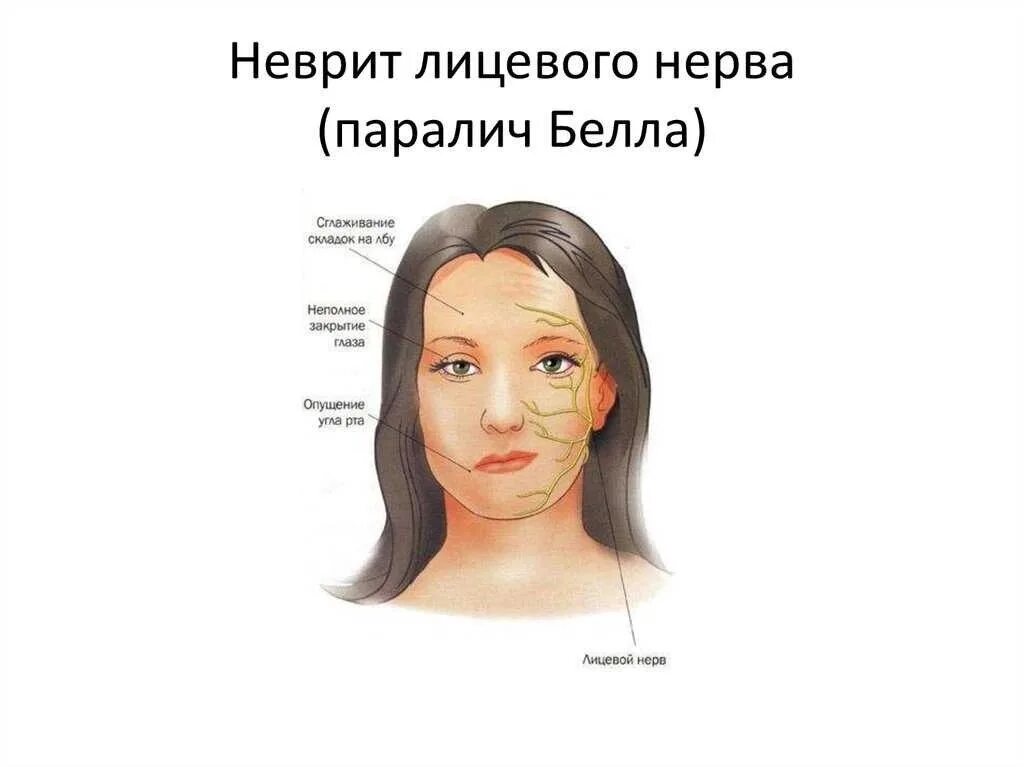 Лицевой нерв последствия. Неврит лицевого лицевого нерва. Неврит лицевого нерва 4 степени. Невралгия тройничного нерва. Неврите лицевого нерва симптомы.