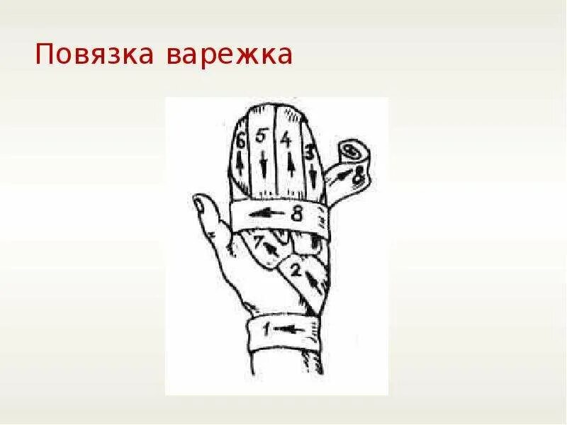 Техника наложения повязки перчатка. Повязка варежка на кисть техника наложения. Продемонстрируйте наложение повязки “варежка”. Наложение повязки варежка алгоритм. Десмургия повязка варежка алгоритм.