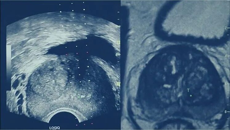 Контроль УЗИ биопсия простаты. Биопсия предстательной железы Фьюжен метод. Фьюжн биопсия предстательной железы мрт.